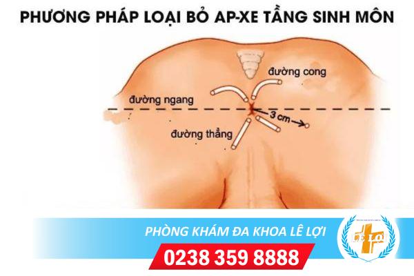 Phương pháp loại bỏ ap-xe tầng sinh môn – Liệu trình một lần duy nhất