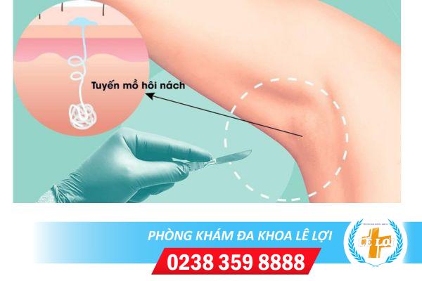 Phương pháp giảm mồ hôi nách hiệu quả