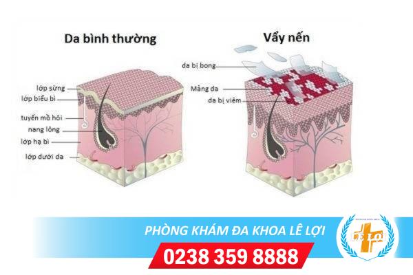Hiện tượng vẩy nến ở dương vật