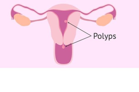 POLYP CỔ TỬ CUNG CÓ NGUY HIỂM KHÔNG?