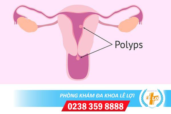 Polyp tử cung có thể nhận biết được không?