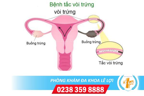 Địa chỉ thông tắc vòi trứng uy tín tại Nghệ An