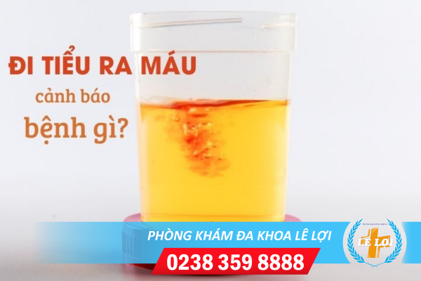 Đi tiểu ra máu là đang mắc bệnh gì?