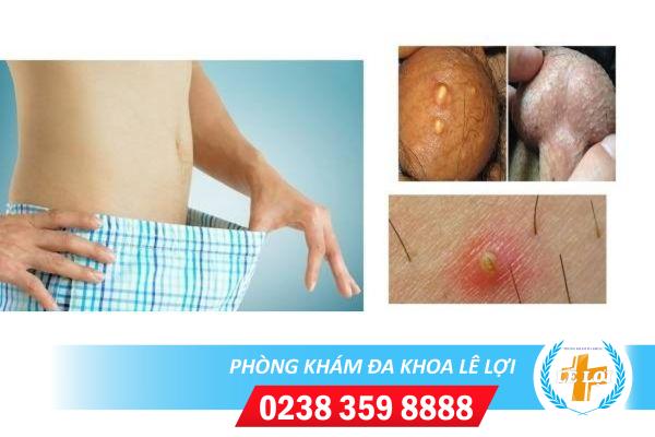 Nổi mụn ở tinh hoàn là dấu hiệu bệnh gì và cách chữa trị