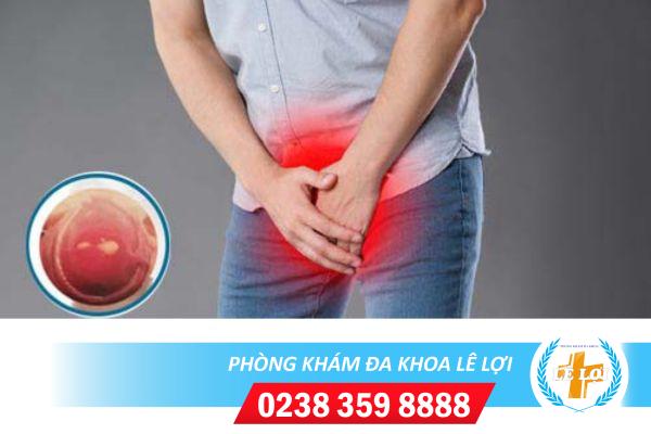 Ngứa lỗ sáo là dấu hiệu của bệnh gì?