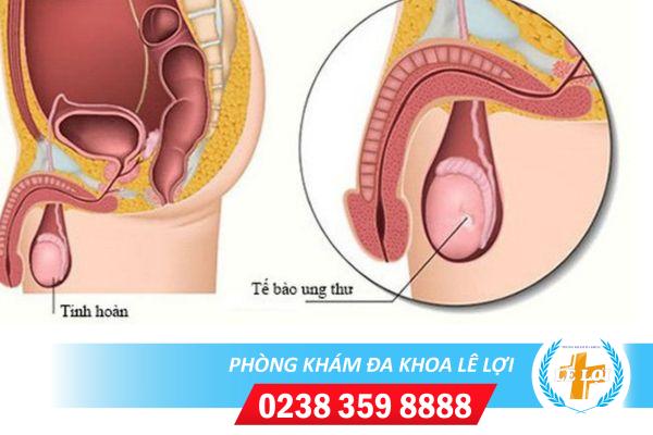 Dấu hiệu nhận biết ung thư tinh hoàn và cách điều trị hiệu quả
