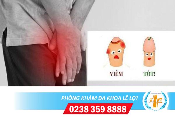 Nguyên nhân nổi mụn ở lỗ sáo và cách điều trị hiệu quả