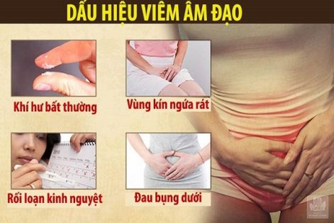 Phải làm sao để hết viêm âm đạo?