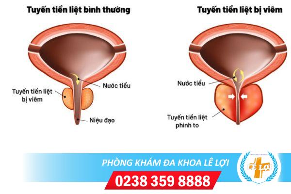 Viêm tuyến tiền liệt ảnh hưởng đến sức khỏe như thế nào ?
