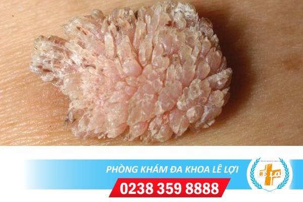 Cách chữa sùi mào gà tại nhà nào hiệu quả?