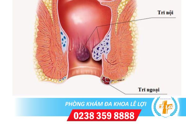 Cách chữa bệnh trĩ hiệu quả không lo tái phát