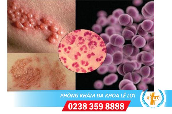 Tác hại của bệnh lậu