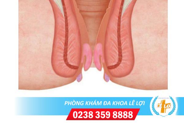 Các phương pháp điều trị sa búi trĩ