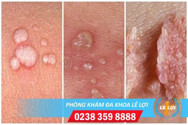Bệnh HPV là gì làm thế nào để nhận biết?