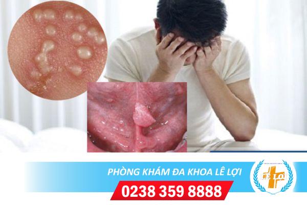 Sùi mào gà vùng kín nam dấu hiệu và cách chữa trị