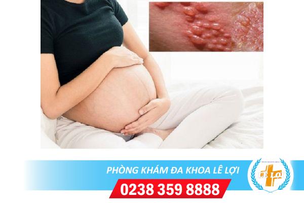 Sùi mào gà khi đang mang thai dấu hiệu và cách điều trị