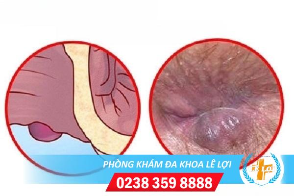 Điều trị trĩ ngoại – Địa chỉ uy tín