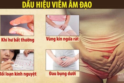 Viêm âm đạo chữa trị như thế nào – Lê lợi địa chỉ điều trị tốt nhất