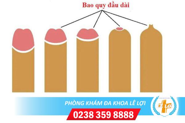 Những điều cần biết về tình trạng dài bao quy đầu ở nam giới