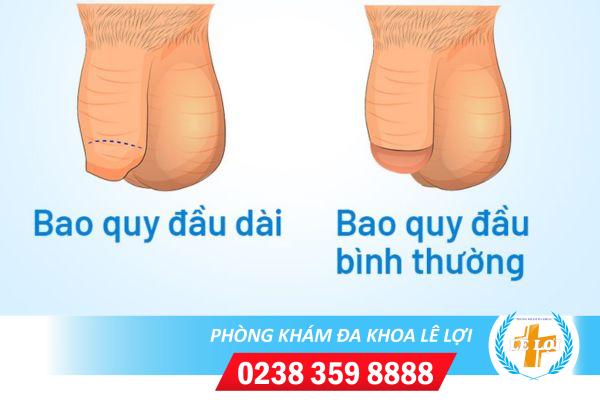 DẤU HIỆU NHẬN BIẾT DÀI BAO QUY ĐẦU