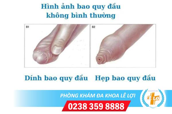 Dính bao quy đầu có nguy hiểm không?