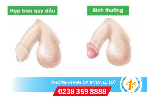 Các dấu hiệu hẹp bao quy đầu ở nam giới không nên chủ quan
