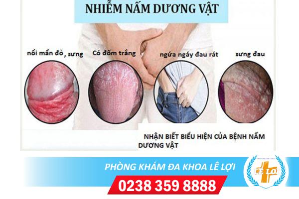 Bệnh nấm ở nam giới và cách hỗ trợ điều trị kịp thời