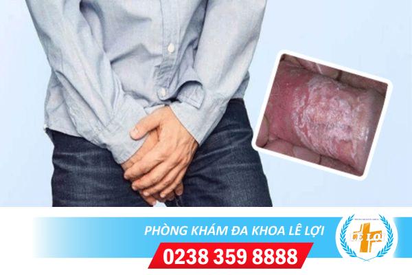 Những nguy hiểm từ triệu chứng nấm dương vật ở nam giới