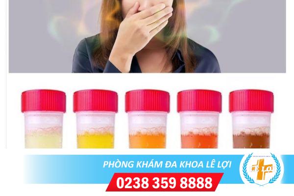 Nguyên nhân nước tiểu có mùi hôi và phương pháp hỗ trợ điều trị