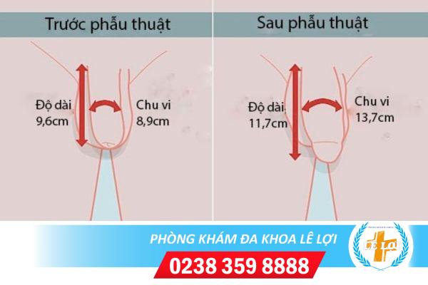 Giá tiền phẫu thuật chỉnh hình dương vật hiệu quả