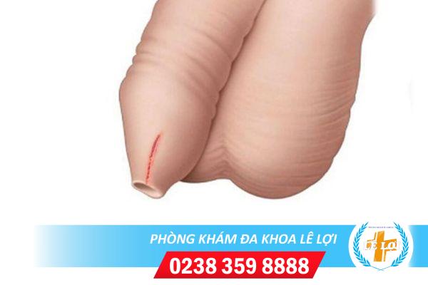 Khi bị rách bao quy đầu cần xử lý thế nào?