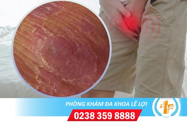 Tróc da quy đầu là bị bệnh gì?