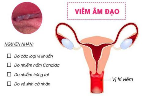 Dấu hiệu nhận biết bị viêm âm đạo