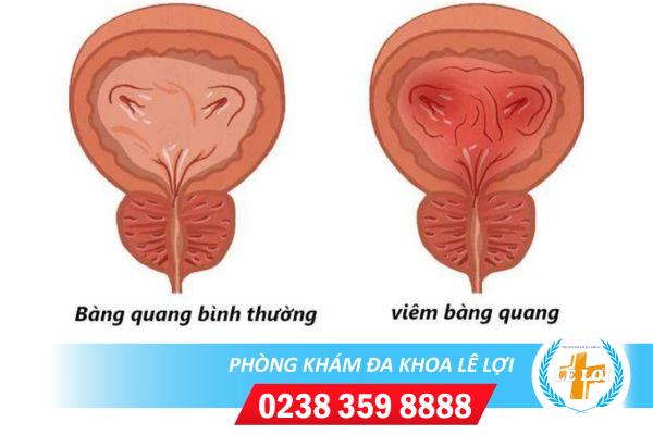 Bệnh viêm bàng quang và những kiến thức cần biết