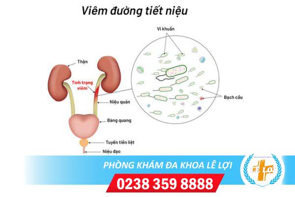 Những biện pháp hỗ trợ chữa viêm đường tiết niệu tốt hiện nay
