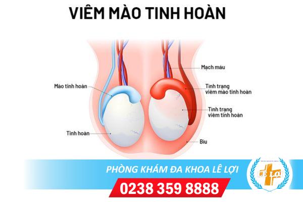 Tìm hiểu về bệnh viêm mào tinh hoàn