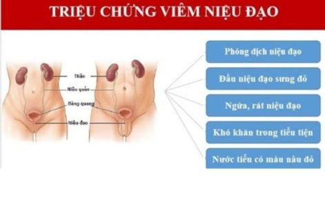 Hiện tượng viêm niệu đạo ở nữ giới