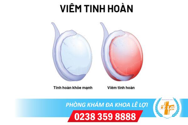 Dấu hiệu của bệnh viêm tinh hoàn ở nam giới