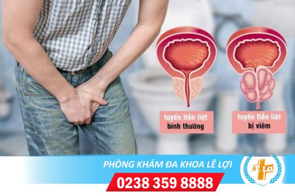 Viêm tuyến tiền liệt và các mối nguy hiểm tiềm ẩn