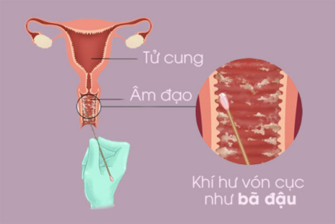 Khí hư vón cục là bị bệnh gì cách điều trị