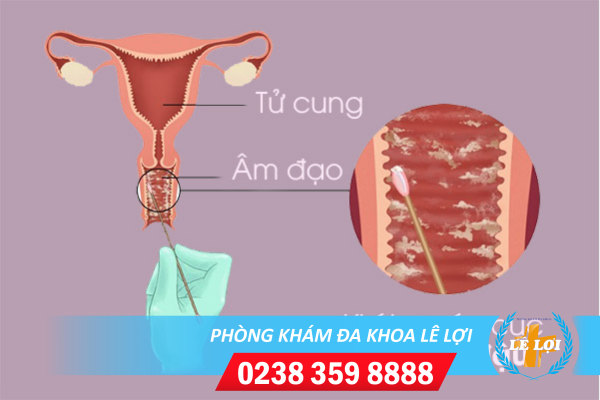 Khí hư vón cục là bị bệnh gì cách điều trị