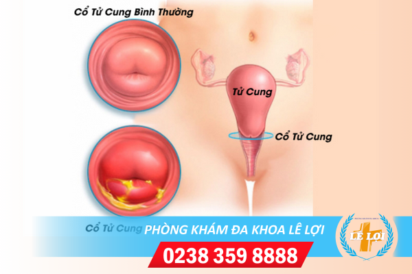 Chi phí chữa viêm cổ tử cung hết bao nhiêu tiền?