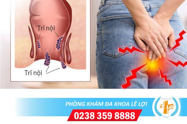 Các phương pháp điều trị bệnh trĩ an toàn, hiệu quả