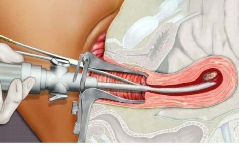 Những điều cần chú ý trước và sau khi hút thai. Lời khuyên của bác sĩ với sức khỏe thai sản