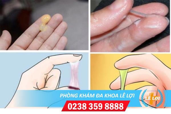 Huyết trắng vón cục là dấu hiệu bệnh gì ?