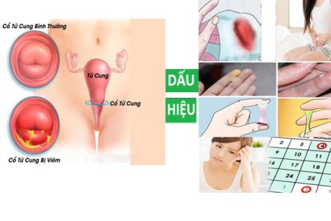 Nên Hỗ Trợ Điều Trị Viêm Cổ Tử Cung Ở Đâu Tốt Ở TP.VINH