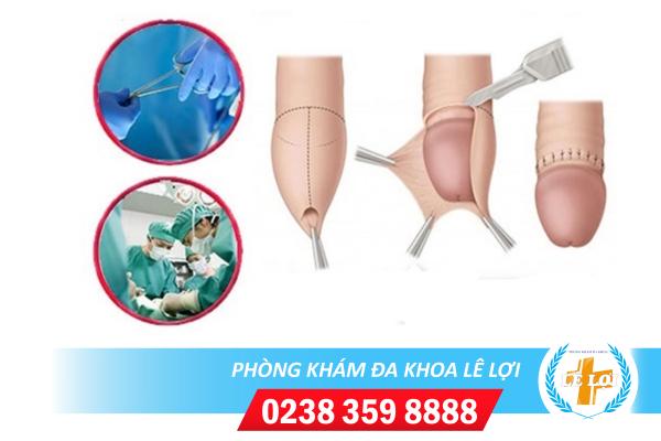 DÀI BAO QUY ĐẦU VÀ PHƯƠNG PHÁP CHỮA DÀI BAO QUY ĐẦU