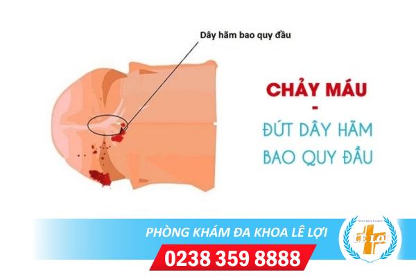 Đứt dây hãm bao quy đầu có sao không?