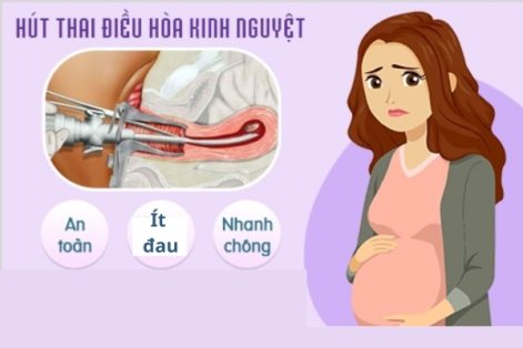 Hút điều hòa kinh nguyệt bỏ thai an toàn