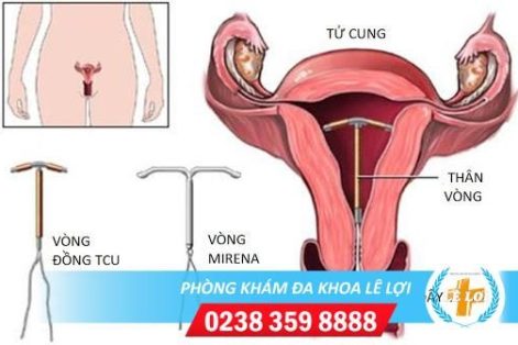 Tháo vòng tránh thai những điều bạn nên biết